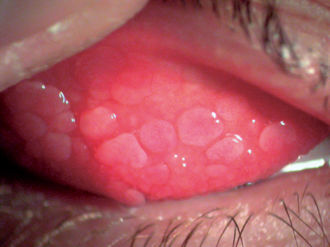 conjonctivite bactérienne